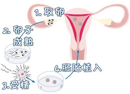 无精症